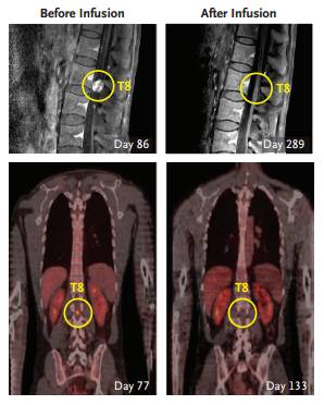 患者脊柱位置转移瘤在不同治疗时间的成像示意图