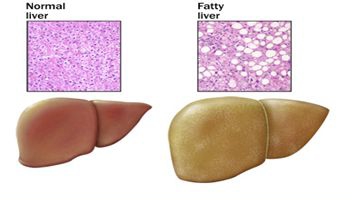 科学家利用人类诱导多能干细胞成功建立非酒精脂肪肝模型