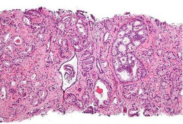 BMC Cancer：利用特殊生物标志物或有望开发出<font color='red'>前列腺癌</font>的新型个体化疗法