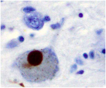 Science：在帕金森病早期进行抗氧化剂治疗有望阻止神经退化，改善<font color='red'>神经元</font>功能