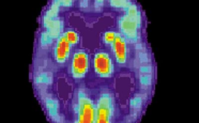 Nat Commun：科学家们找到阿兹海默症的最早期大脑症状