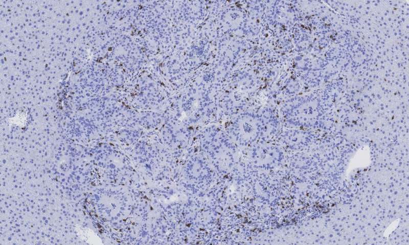 两篇Nature揭示TGF-β促进癌症逃避免疫检测