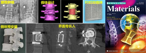 高强韧多孔钛合金人工骨材料研发取得突破