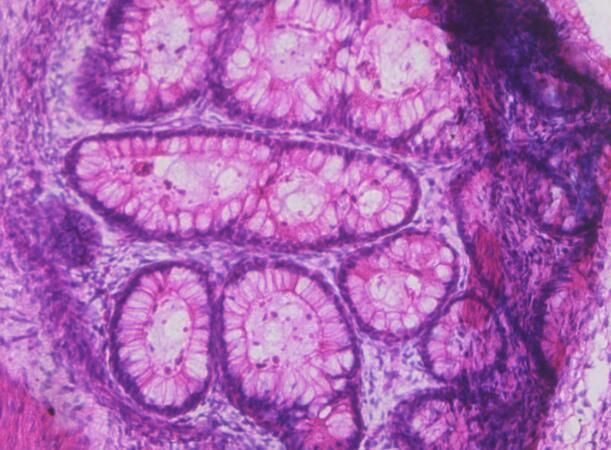 Cell Stem Cell：科学家利用畸胎瘤成功衍生出肌肉干细胞