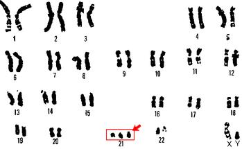 一种新型的敏感生物<font color='red'>传感器</font>有望快速诊断唐氏综合征