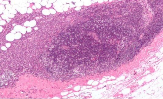 Cell Rep：科学家鉴别出参与乳腺癌细胞增殖及<font color='red'>疗法耐受性</font>的关键酶类