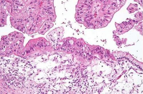 Cancer Res：揭示卵巢癌在体内生长和进化的分子机制