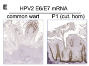 树人综合征患者为HPV-2感染