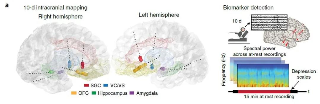 图注：SEEG电极在大脑中的分布位置以及对生物标志物的检测