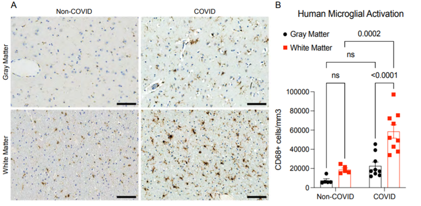 SARS-CoV-2感染后人白质小胶质细胞的反应性（图源：bioRxiv）