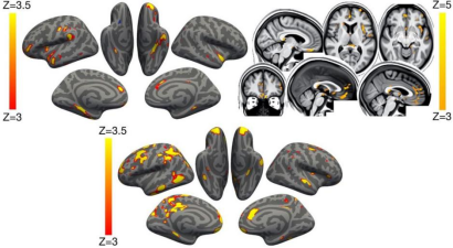 图2 患者大脑灰质损失的脑部区域（图源：Nature）