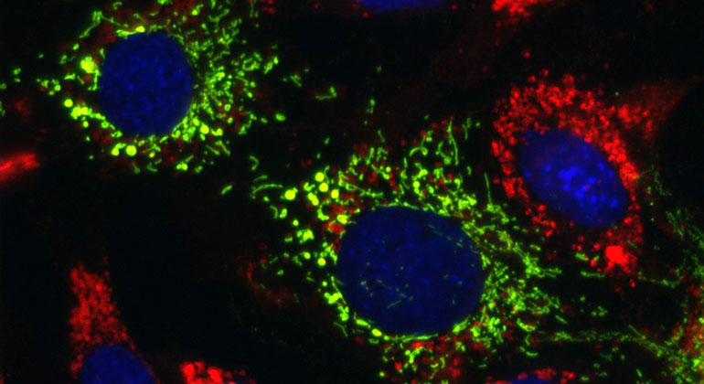 当线粒体TRAP1(绿色)被激活时，来自尼曼-匹克病C1型细胞的脂质填充溶酶体(红色)被规范化