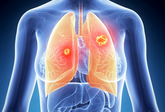 携带siRNA纳米颗粒可抑制肺癌细胞