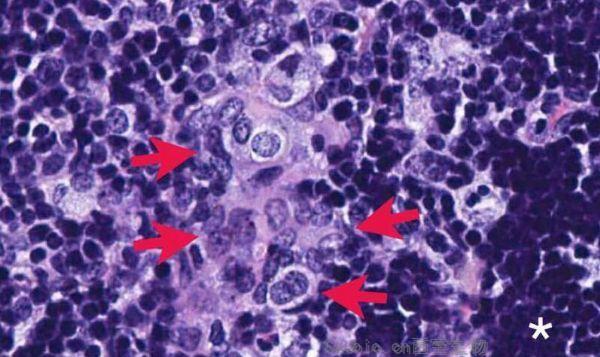 JCB：科学家鉴别出转移性前列腺癌的潜在<font color='red'>治疗靶点</font>