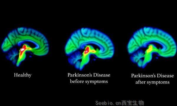 Lancet Neurol：研究揭示了<font color='red'>帕金森</font>的大脑根源