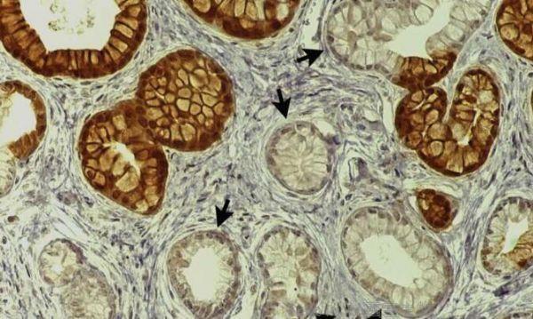 CMGH：揭秘慢性胰腺炎诱发胰腺癌发生的分子机制