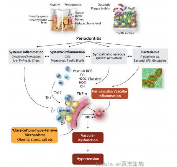 Cardiovasc Res：牙龈疾病与高血压风险较高有关