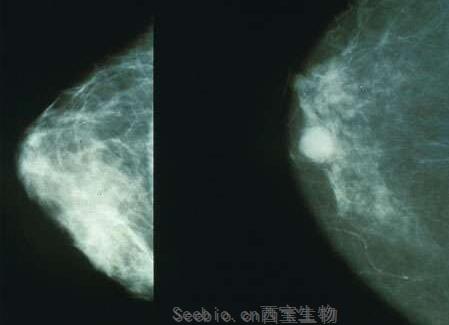 Mol Cancer Res：鉴别出关键靶点有望开发出治疗三阴性乳腺癌的新型疗法