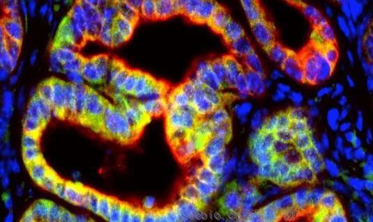 Cancer Res：胰腺癌细胞或会分泌特殊信号来阻断机体对肿瘤的免疫攻击