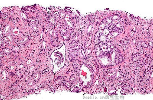 NEJM重大进展：乳腺癌药物治疗<font color='red'>前列腺癌</font>比标准疗法更有效！