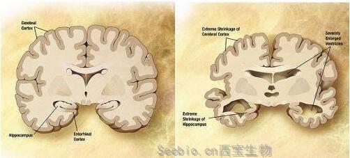 Nat Commun：揭秘毒性tau蛋白在阿尔兹海默病患者<font color='red'>大脑</font>中扩散的分子机制