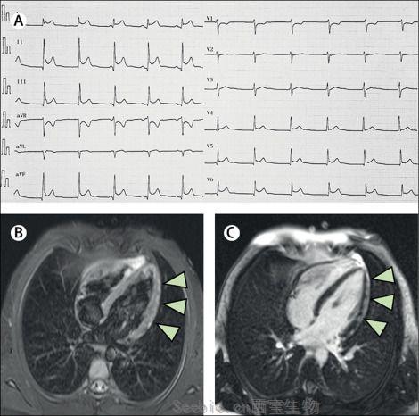 Lancet：一名感染SARS-CoV-2的16岁男孩患上心肌炎