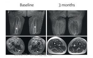 《柳叶刀》：首次成功利用<font color='red'>CAR-T细胞</font>治疗严重肌肉炎症
