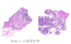 研究揭示了同时发生APC和MLH1种系突变的结直肠肿瘤的体细胞突变谱