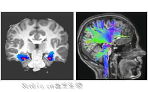 Nature Medicine：一种新的强迫症神经<font color='red'>生物标志物</font>
