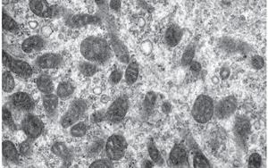 《科学转化医学》:2型糖尿病患者的肌肉能量产生是如何受损的 《科学转化医学》:2型糖尿病患者的肌肉能量产生是如何受损的