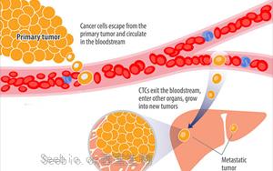 Nature Medicine一项开创性的新研究可防止<font color='red'>乳腺癌</font>复发